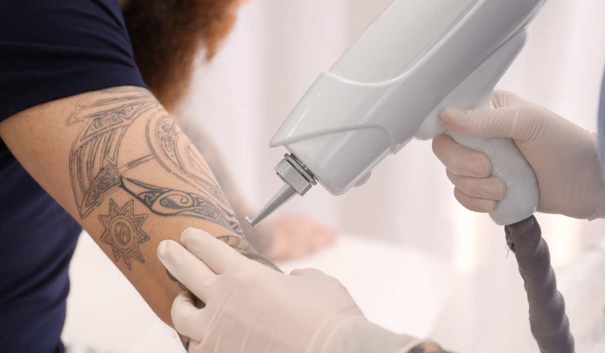 Remoção de Tattoo: tudo o que você precisa saber sobre